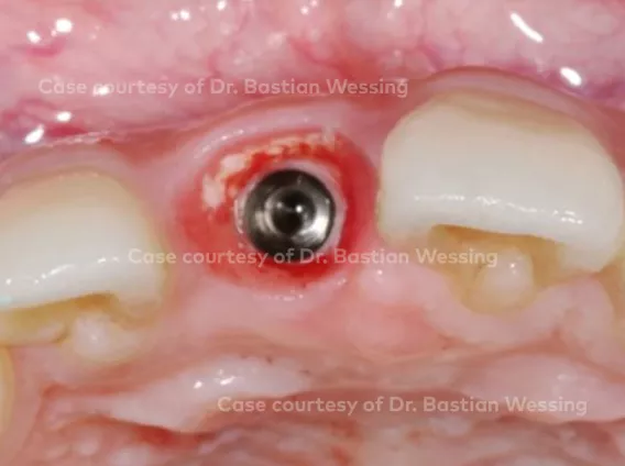 Buccal bone augmentation during immediate implant placement