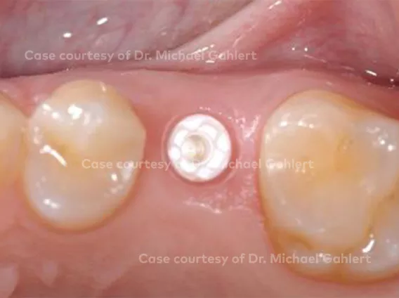 Single tooth restoration with NobelPearl™