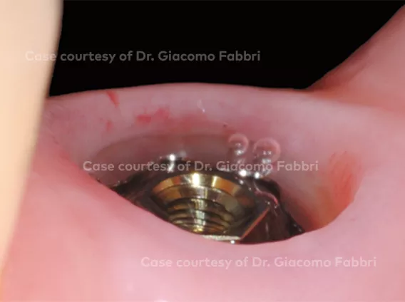 Single-tooth replacement in the posterior region using the On1™ concept