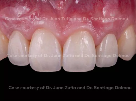 Restoration of both lateral superior incisors with narrow platform implants
