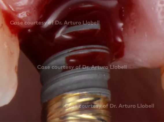 Immediate provisionalization of a central incisor