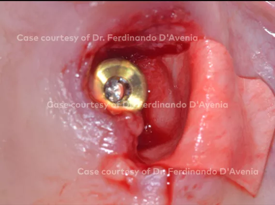 Immediate implant placement in a site with severe buccal dehiscence