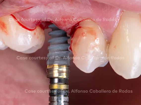 Nobel Biocare N1™ system with immediate loading