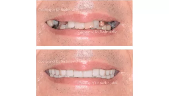 Clinical applications of TiUltra™ implants and Xeal™ abutments in full-arch and individual restorations