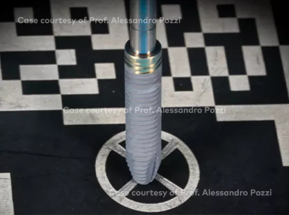 NobelParallel™ Conical Connection TiUltra™ Implant & X-Guide® for immediate loading of single implants in the esthetic zone in one visit