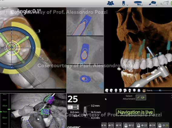 Full-arch immediate loading in the maxilla and single molar in the mandible