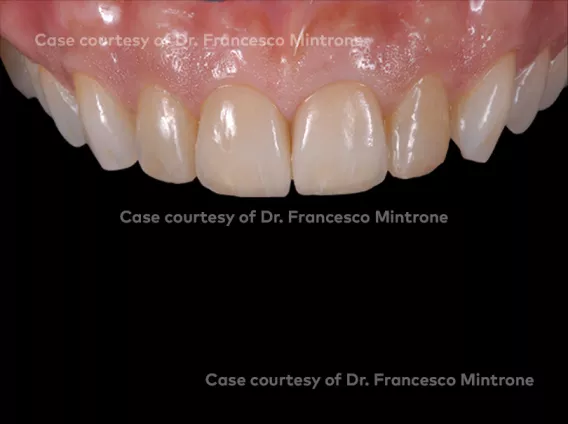 N1™ Base, Anterior case
