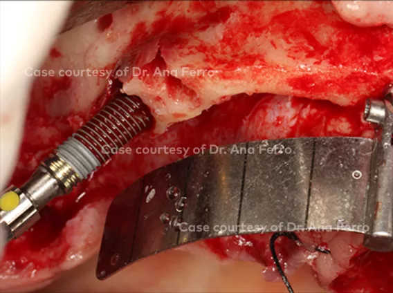 All-on-4® treatment concept high skilled with NobelParallel™ CC TiUltra™ implant and Multi-unit Abutment Xeal™