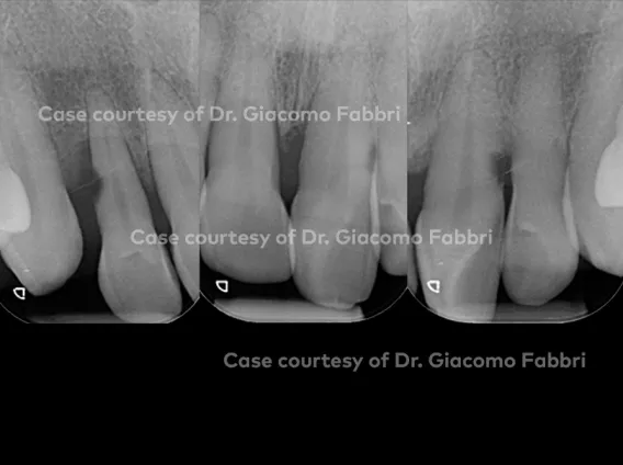 Challenging anterior multidisciplinary rehabilitation using Nobel Biocare N1™ implant system