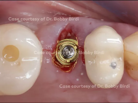 Immediate implant placement and provisionalization of a maxillary premolar
