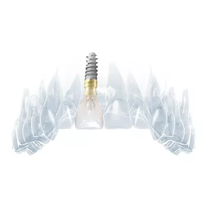 Esthetic digital workflow for single tooth rehabilitation
