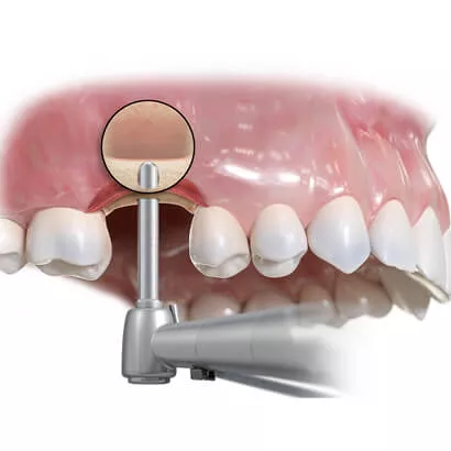 NovaBone® Putty: next-gen synthetic graft