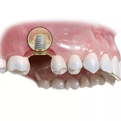 NovaBone® Putty: next-gen synthetic graft