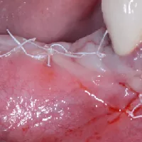 membrane exposure