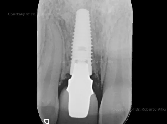 7-year follow-up  of a central maxillary incisor restoration