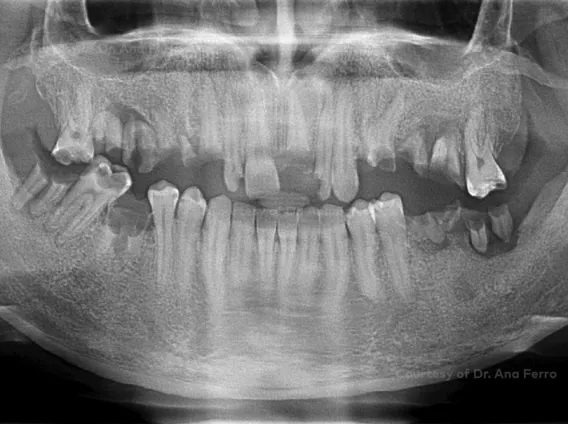 Rehabilitation of a young patient with a severely degraded dentition