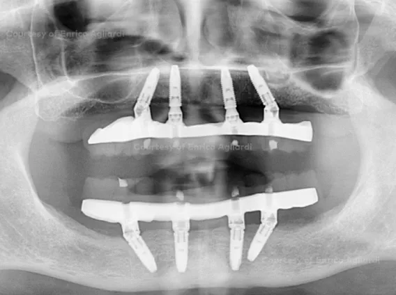All-on-4® treatment concept clinical case