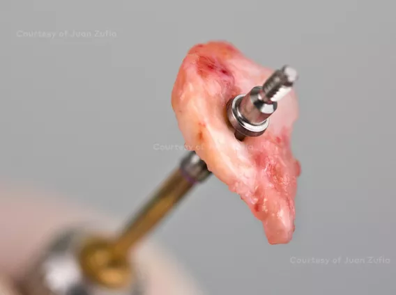 Anterior restoration using advanced tissue grafting for improved esthetics
