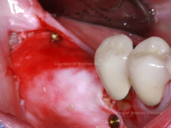 Horizontal and vertical ridge augmentation of a knife-edge ridge
