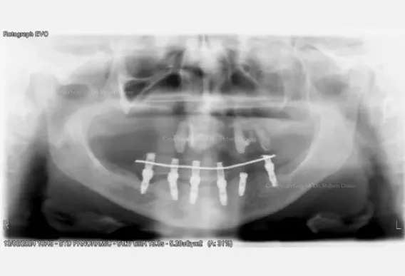 Case courtesy of Dr. Rubén Davó