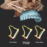 Zygoma