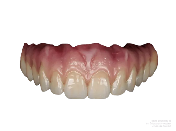 Procera restoration