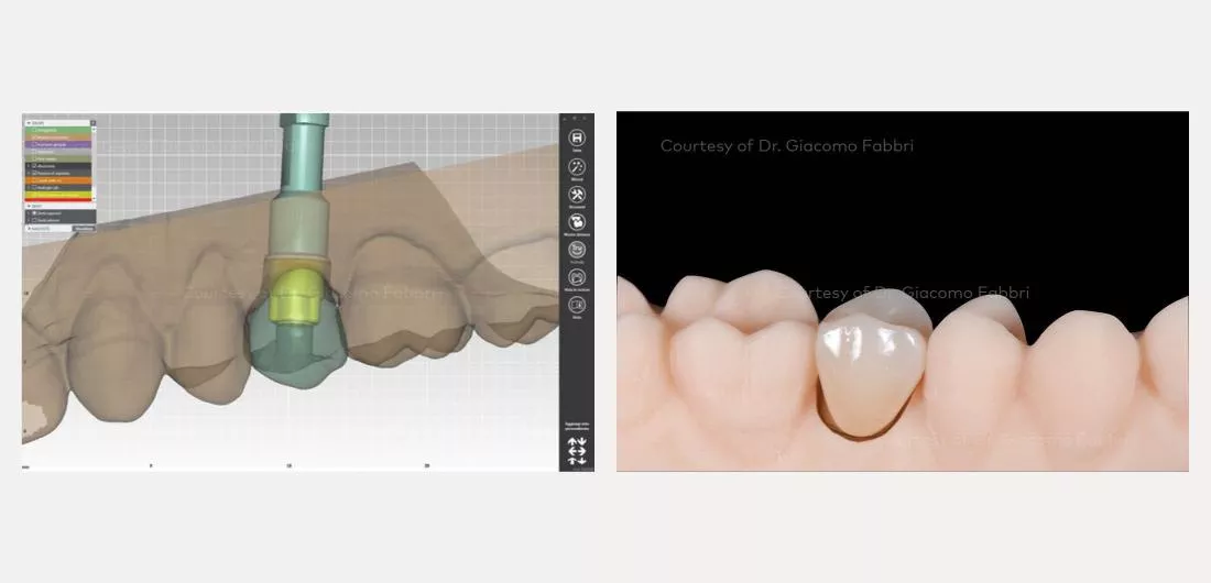 Dr. Fabbri_N1_premolar_case_slider14.