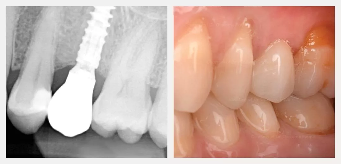 Dr. Fabbri_N1_premolar_case_slider18