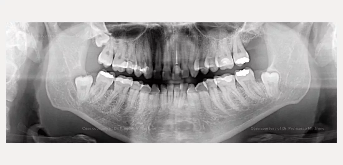 Case courtesy of Dr. Francesco Mintrone