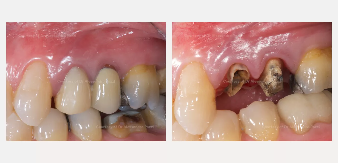 Case courtesy of Prof. Alessandro Pozzi