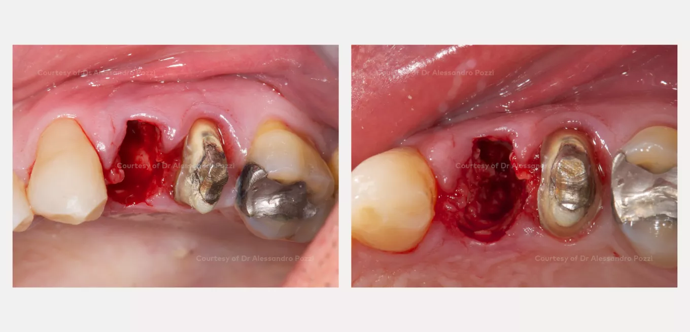 Case courtesy of Prof. Alessandro Pozzi