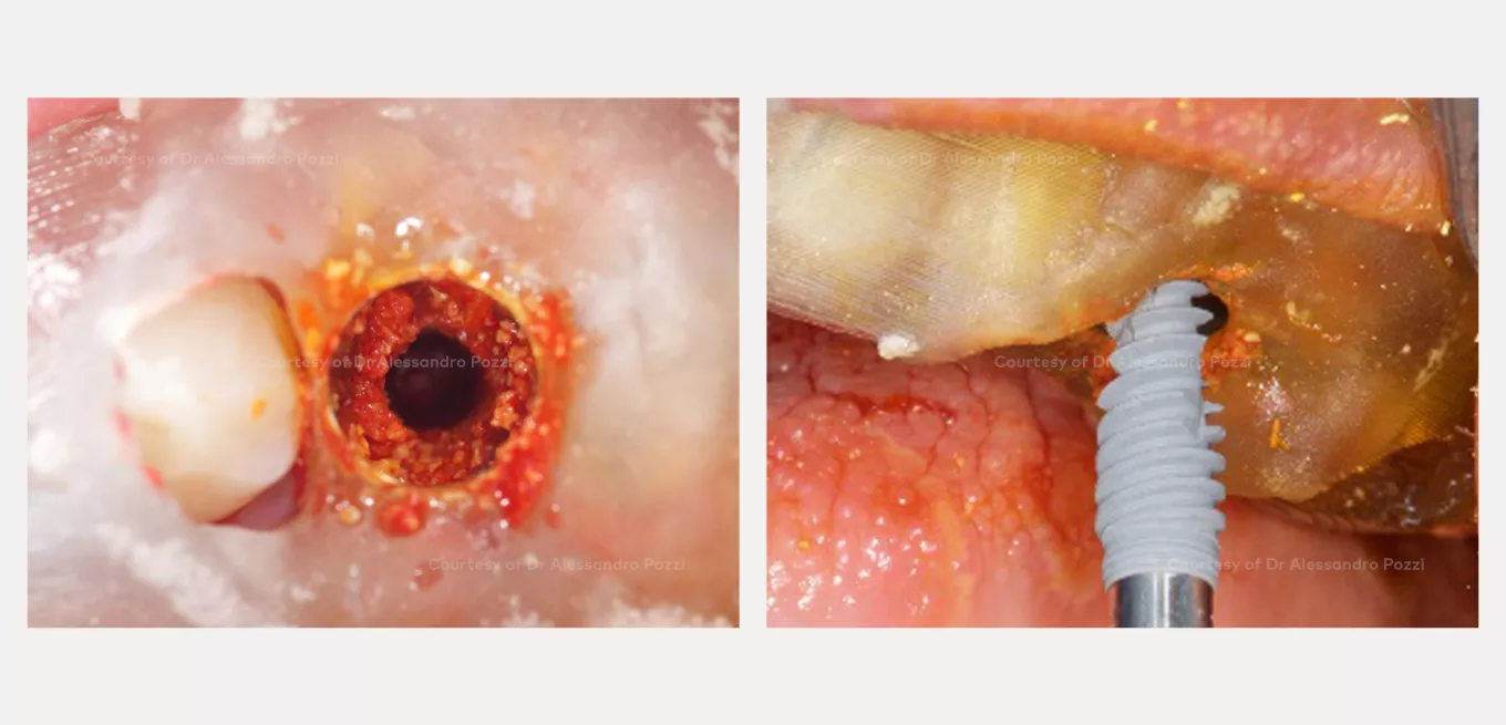Case courtesy of Prof. Alessandro Pozzi
