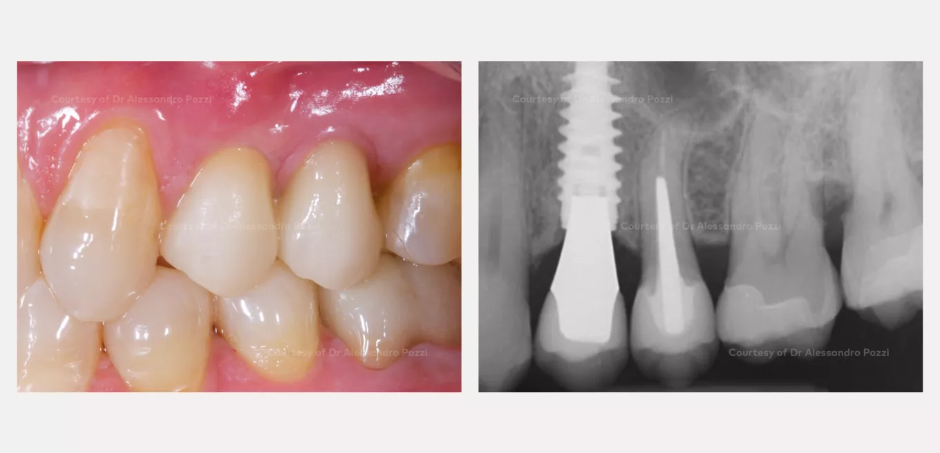 Case courtesy of Prof. Alessandro Pozzi