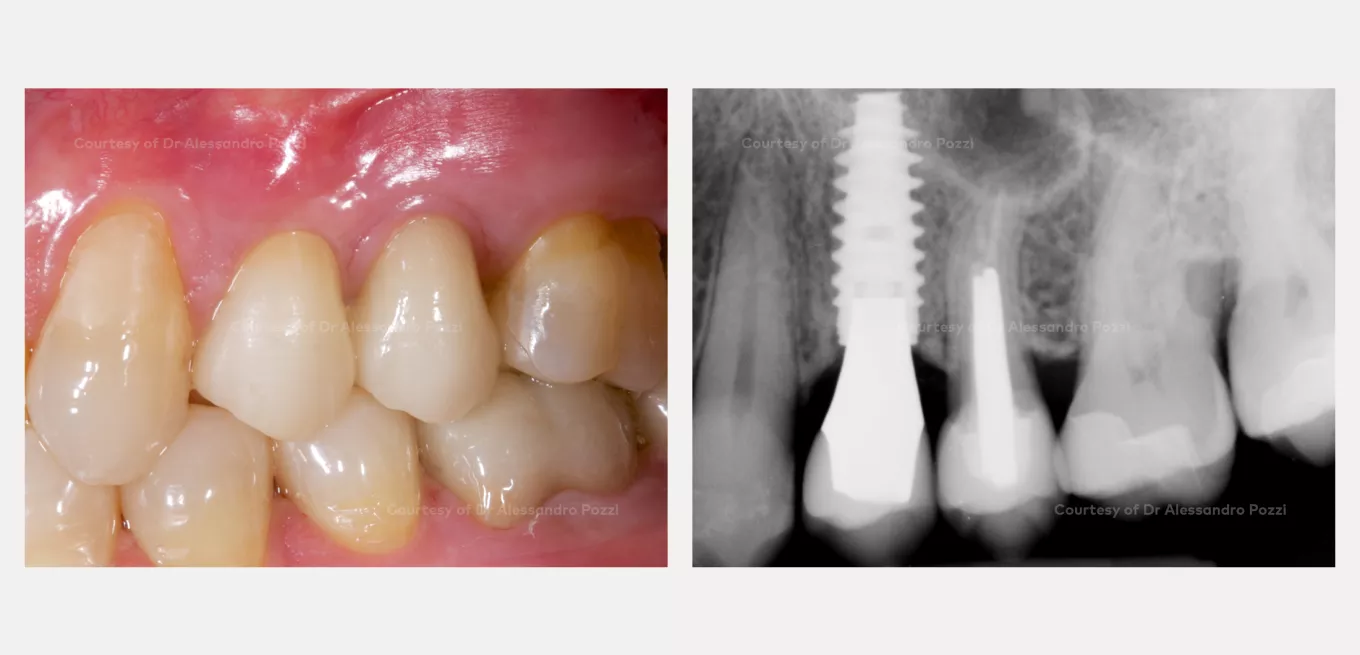 Case courtesy of Prof. Alessandro Pozzi