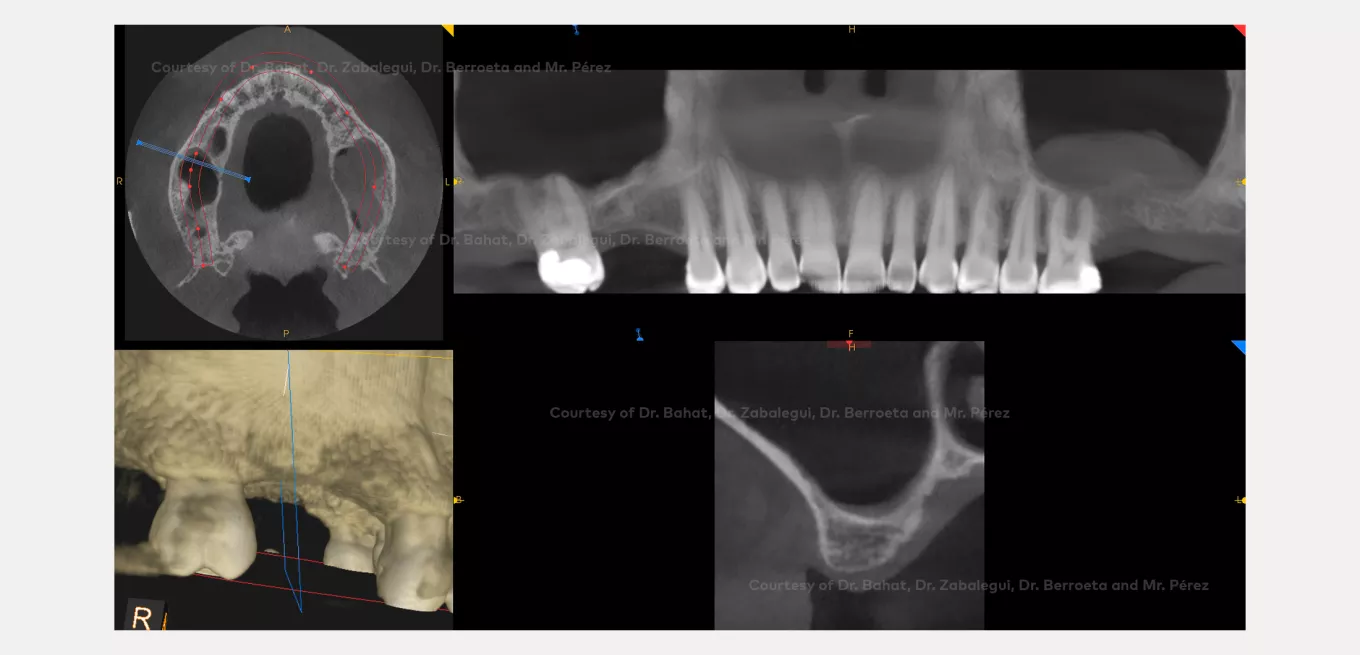 Case courtesy of Dr. Oded Bahat, Dr. Ion Zabalegui, Dr. Eva Berroeta, Mr. Javier Pérez