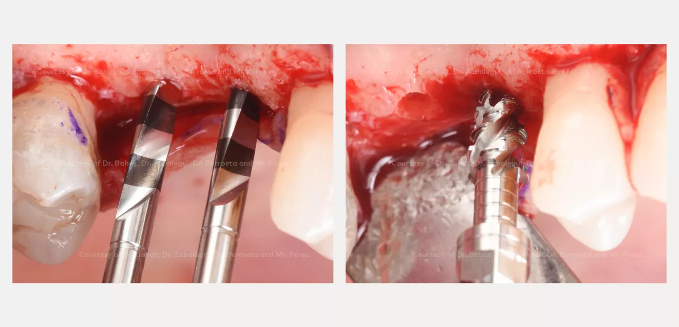 Case courtesy of Dr. Oded Bahat, Dr. Ion Zabalegui, Dr. Eva Berroeta, Mr. Javier Pérez