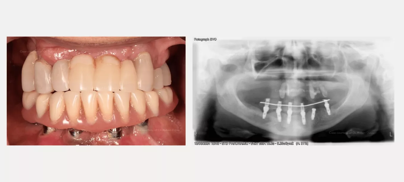 Case courtesy of Dr. Rubén Davó