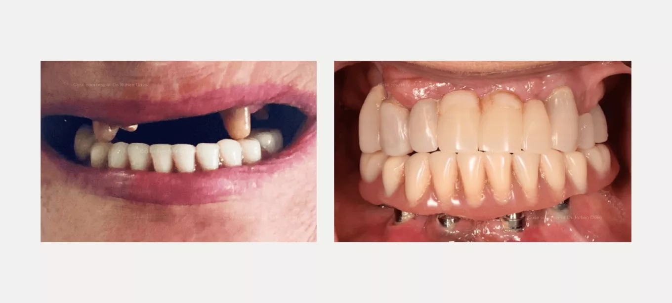 Case courtesy of Dr. Rubén Davó