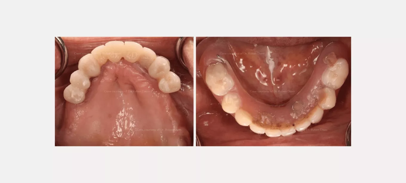 Case courtesy of Dr. Rubén Davó