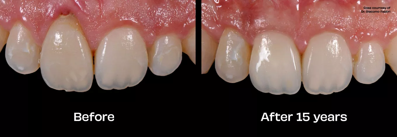 Case courtesy of Dr. Giacomo Fabbri